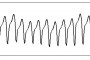 pulso taquicardia ventricular