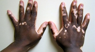 Vitiligo (Medium)