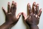 Vitiligo (Medium)