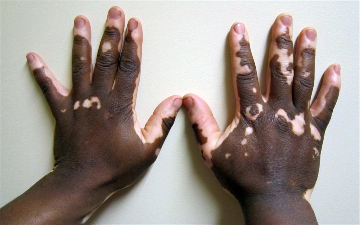 Vitiligo (Medium)